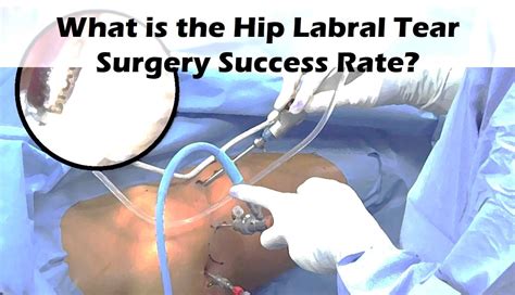 acetabular labral tear surgery recovery